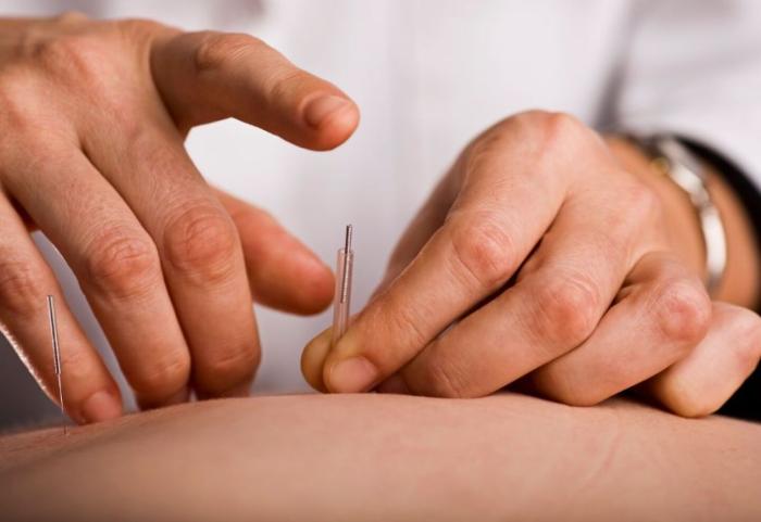 Acupuntura