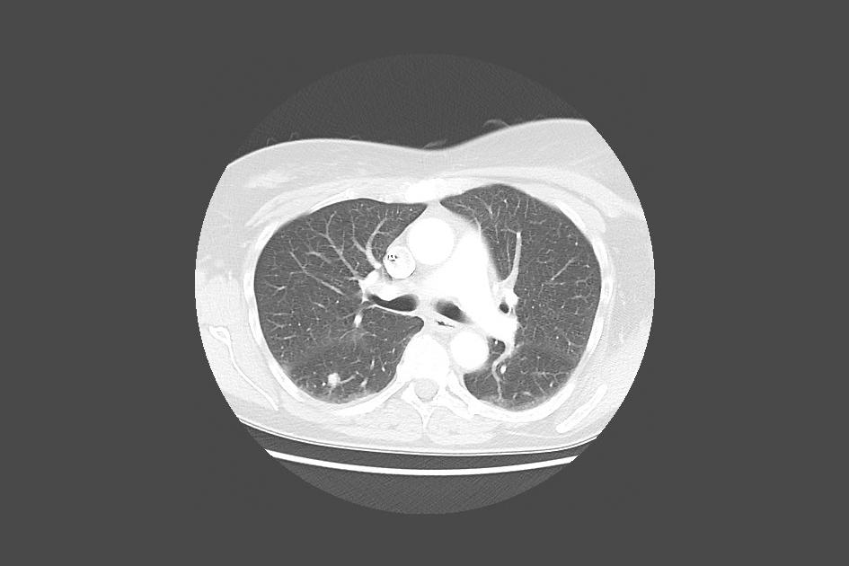 Tomografía de pulmón