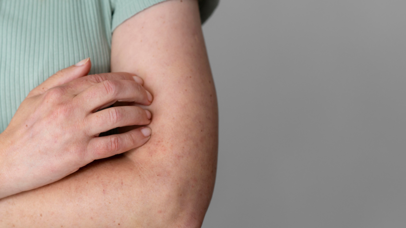 Sarampión Mujer se toca el brazo, que tiene manchitas rojas en la piel